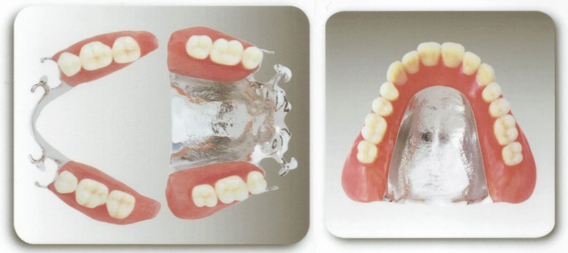 安全性の高いチタンの入れ歯