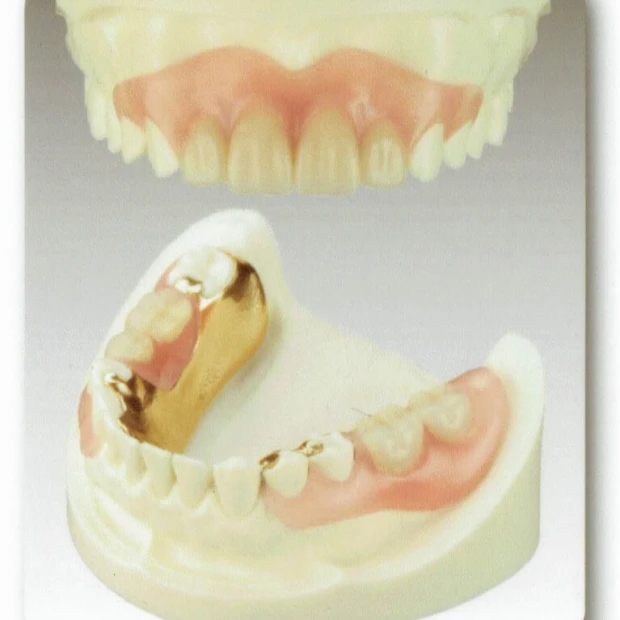 部分入れ歯