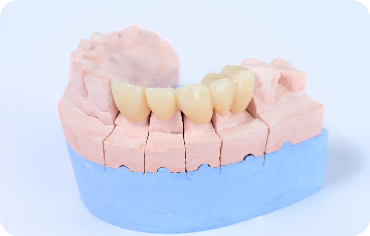 できるだけセラミックが長持ちする治療を