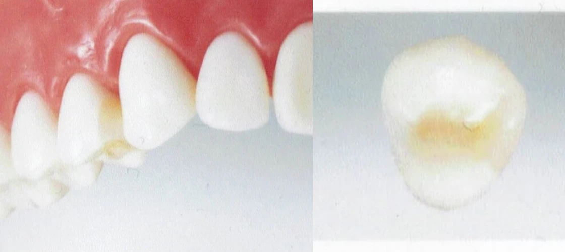 オールセラミックインレー