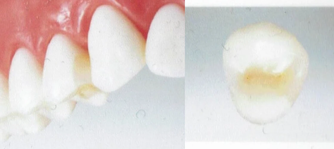 ハイブリッドセラミックインレー