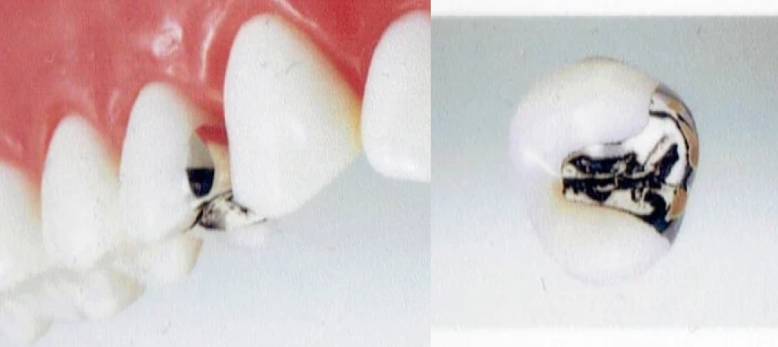 ジルコニアクラウン