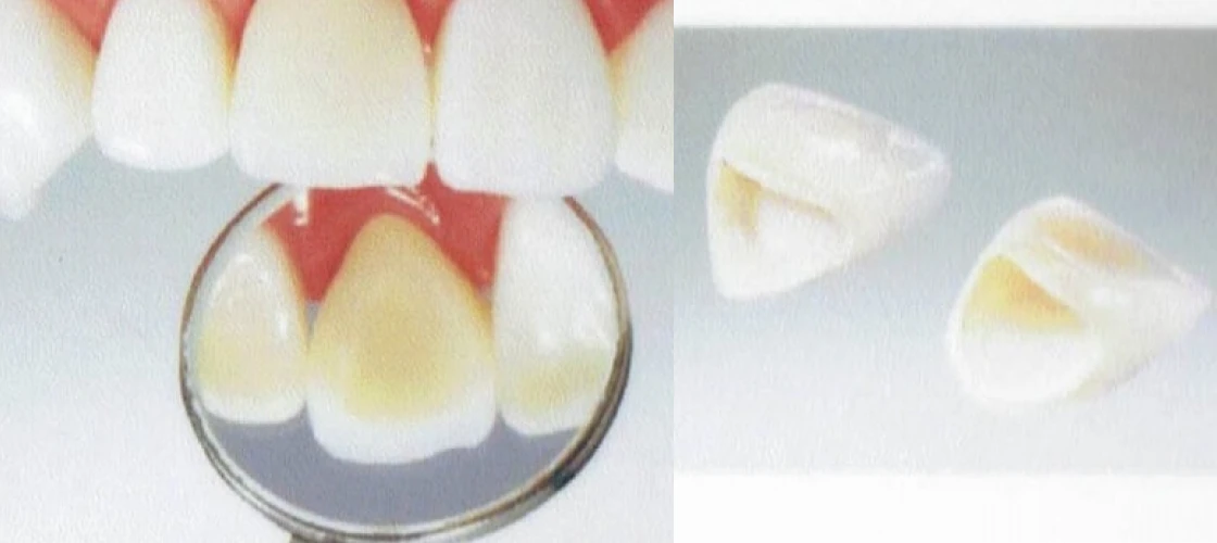 オールセラミッククラウン