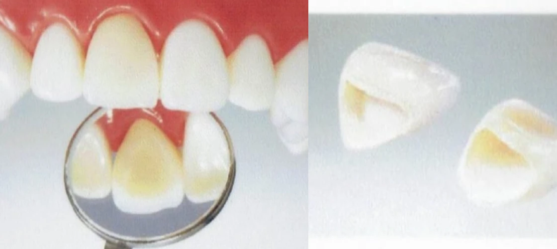 メタルボンドクラウン